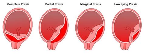 What Causes Extra Lobe On Placenta